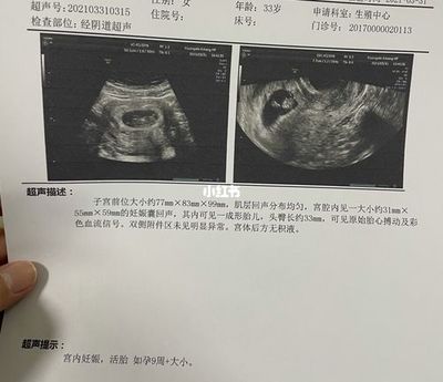 怀孕70天胎儿彩超图