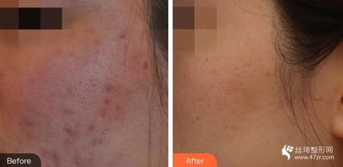 脸上长痘痘用肤大夫