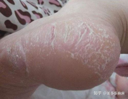 脚麻麻的是怎么回事