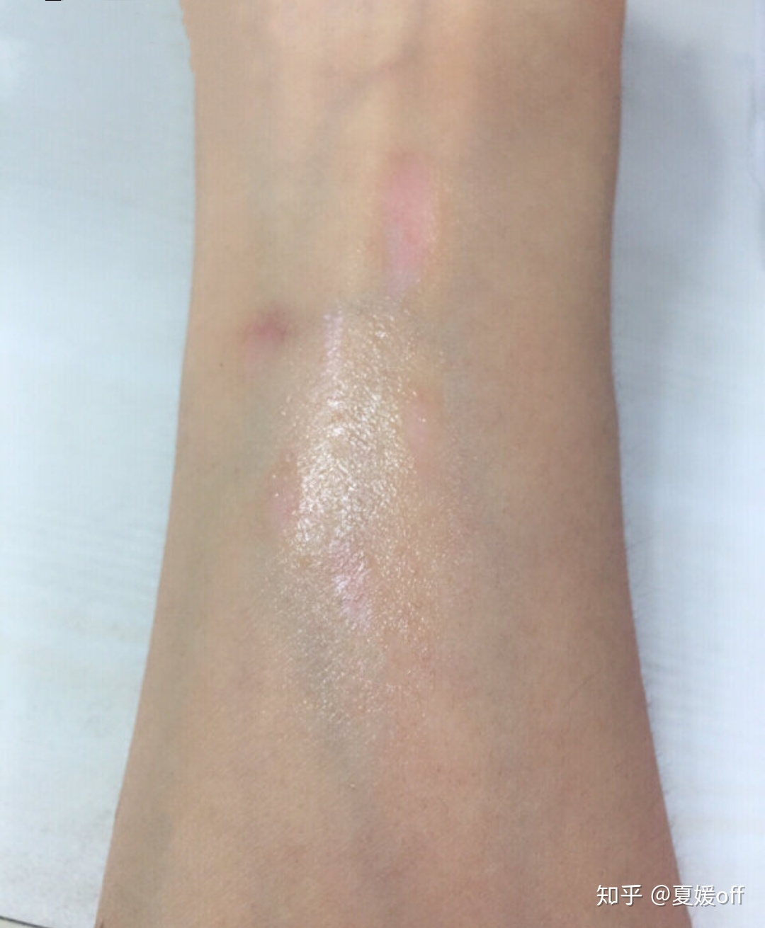 如何去除烫伤的疤痕