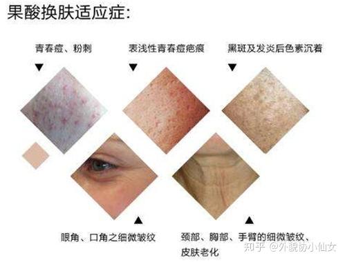 皮秒有痘痘可以做吗
