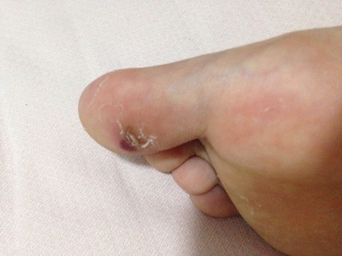 脚趾头疼痛是怎么回事