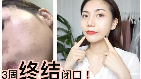 脸颊长闭口痘痘的原因分析