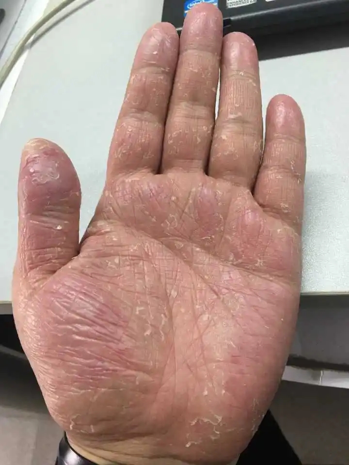 小孩手蜕皮是怎么回事