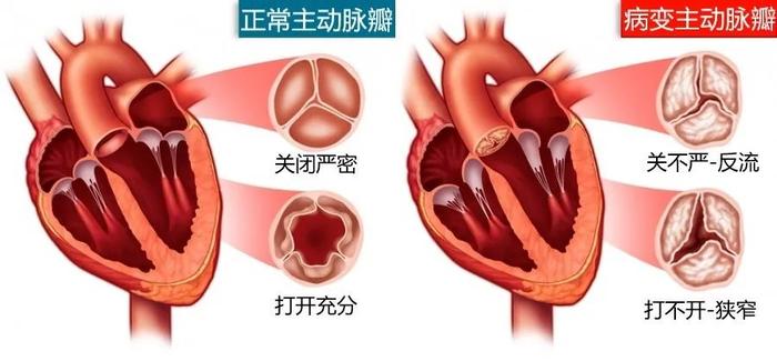 主动脉型心脏怎么治疗