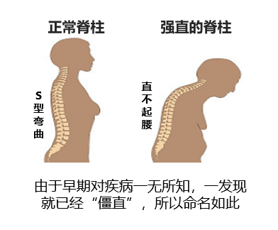 颈椎弯曲怎么治疗