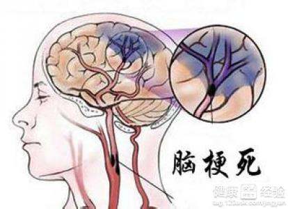 脑梗阻怎么治疗