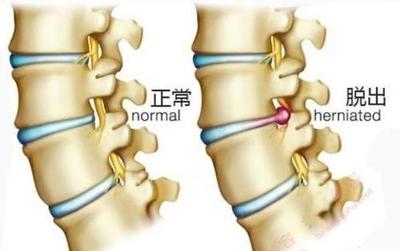 腰间狭窄是怎么回事