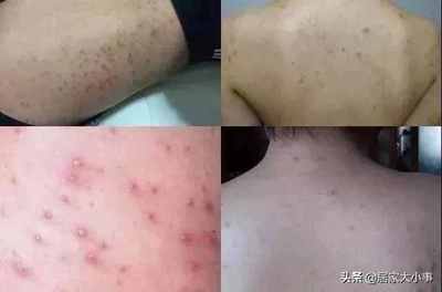 痘痘形成痤疮怎么办