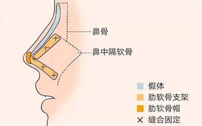 肋骨隆鼻3个月内变化