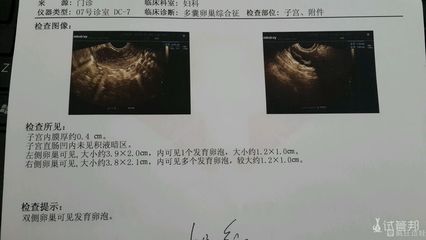 双侧卵巢多囊会怀孕吗
