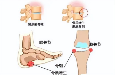 手关节骨质增生怎么治疗好