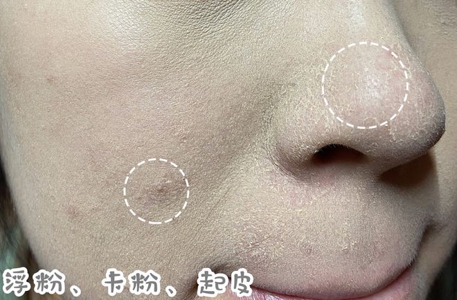 痘痘结巴了怎么上妆