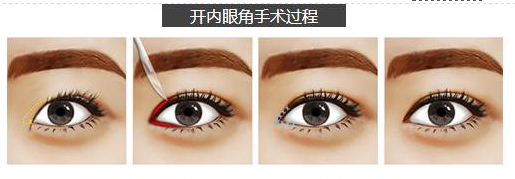 怎样的眼睛适合开眼角