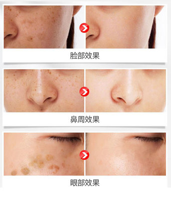眼部黄褐斑