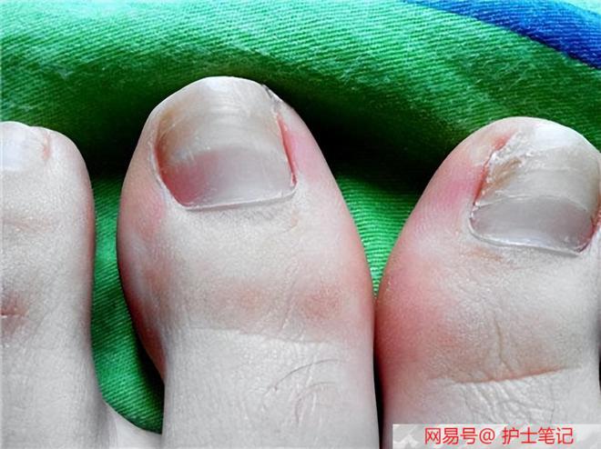 脚趾甲增厚是怎么回事
