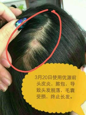 头皮炎怎么治疗