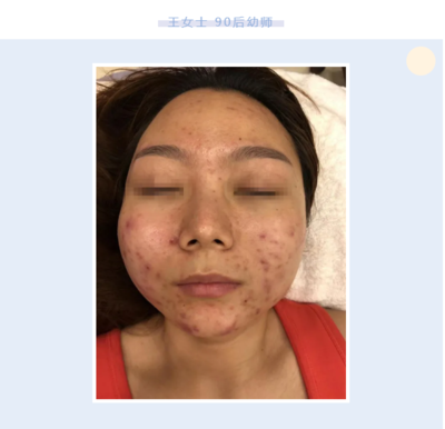 怎样排毒祛痘最有效