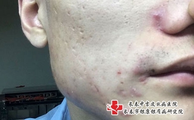 血热引起的痘痘