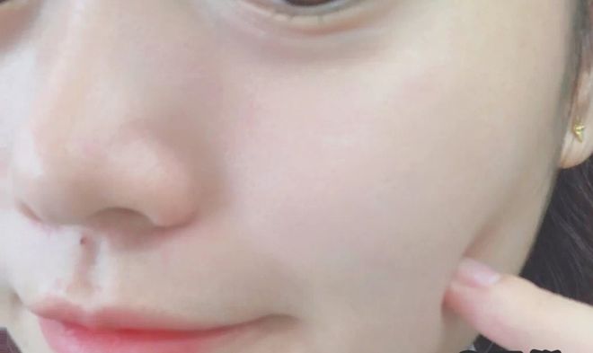 脸上有痘痘敷冰面膜