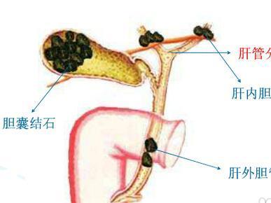肝管结石怎么治疗最好的方法