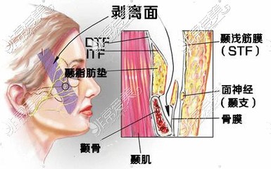 脸部提拉怎么做