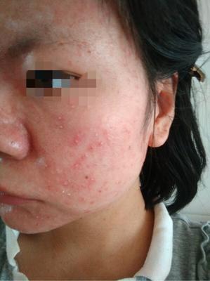 痘痘肌可以光子嫩肤吗