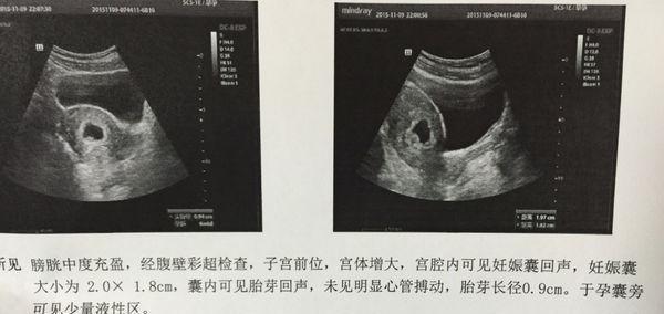 小腹微涨是否怀孕初期