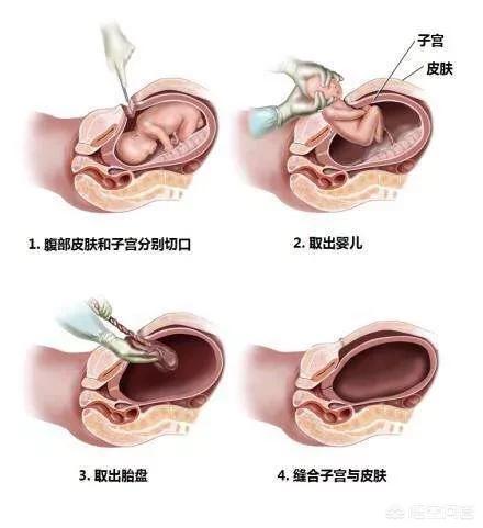 刨腹产得需要多少钱