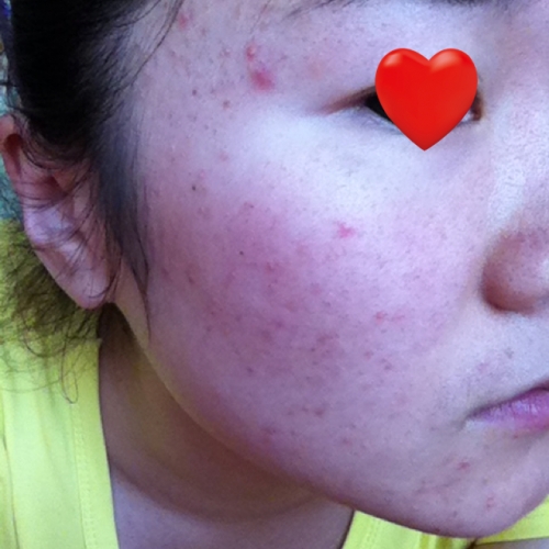 双眼皮埋线处长痘痘