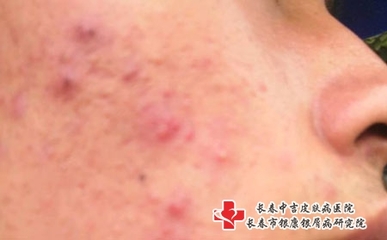 为什么脸上长痘痘和毛孔变大