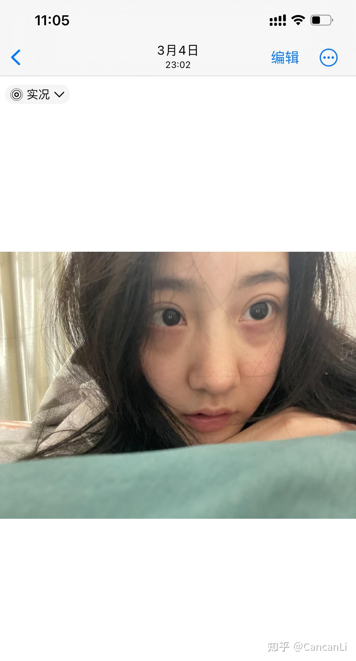 纹完眉毛脸上长痘痘