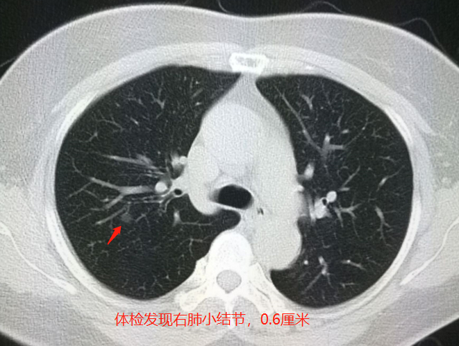 肺小结节会引起咳嗽吗