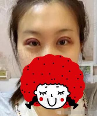 双眼皮上长了个脂肪粒