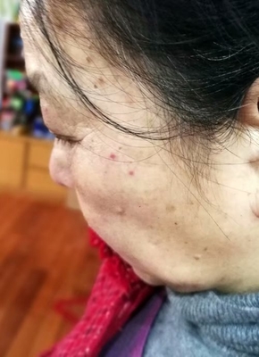隆起的大痘痘