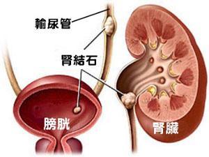 尿道结石一天要喝多少水