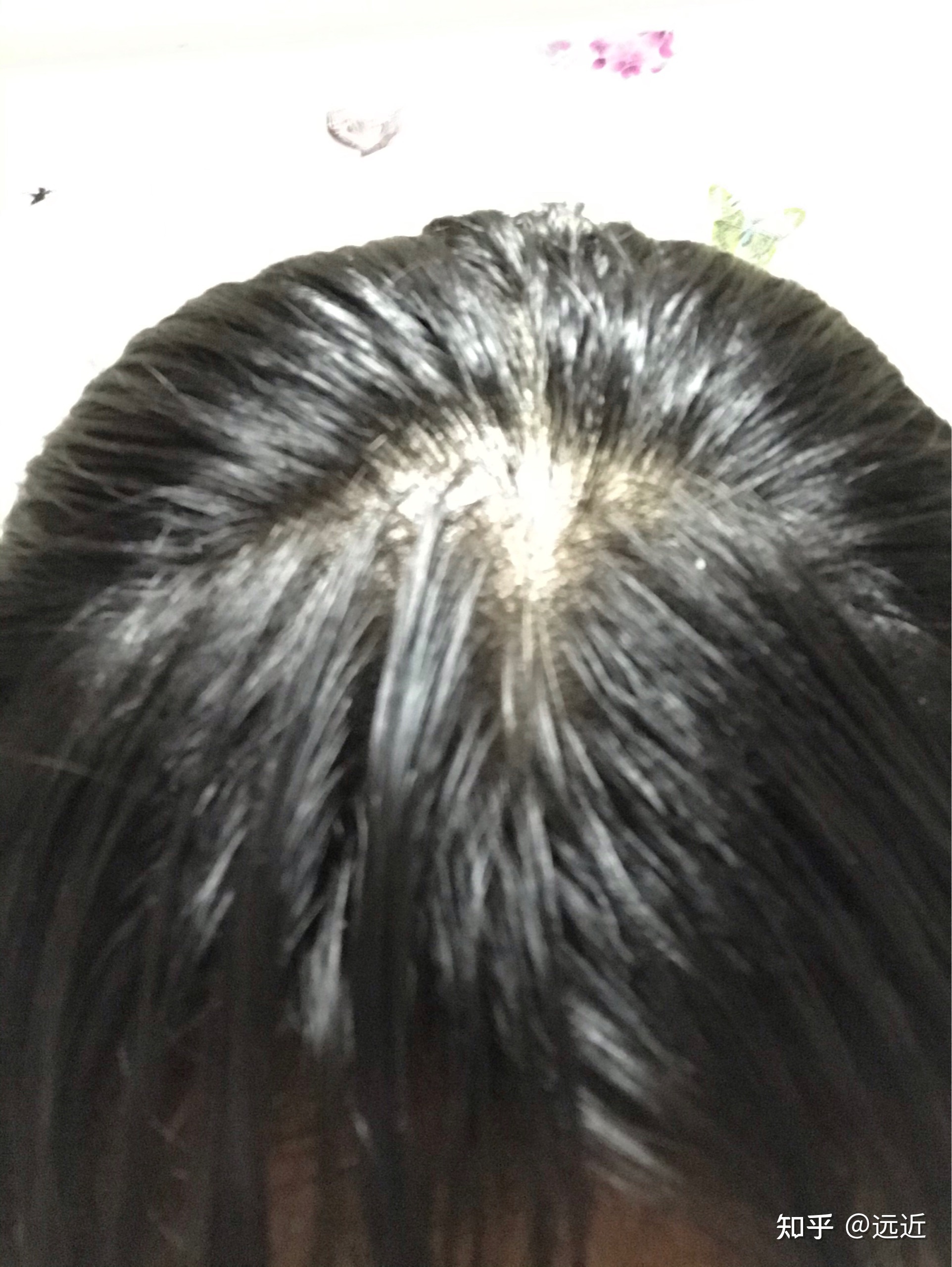 头皮里有小痘痘怎么回事