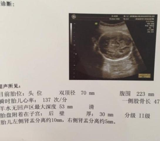 胎儿肾盂分离是什么意思