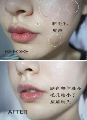 有痘痘可以涂素颜霜