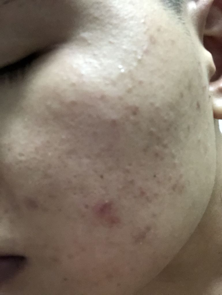 脖子长痘痘怎么治疗