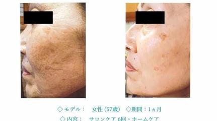水光针能去皱纹吗