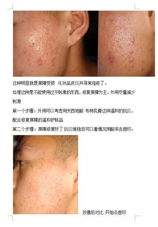 有痘痘用修复屏障