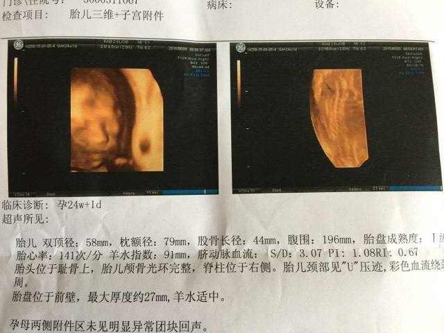 六个月胎儿双顶径标准