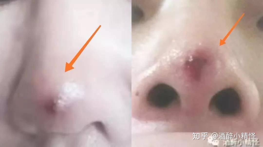 隆鼻后长了颗痘痘