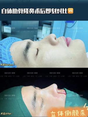 男生隆鼻要多少钱