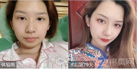 东莞双眼皮询华美