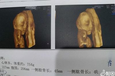 彩超鉴定性别准确率是多少