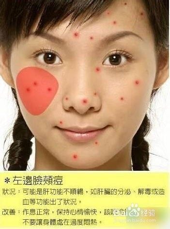 左边面长痘痘怎么办