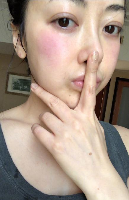 过敏脸肿了是怎么回事