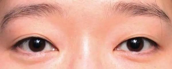 双眼皮埋线处长痘痘